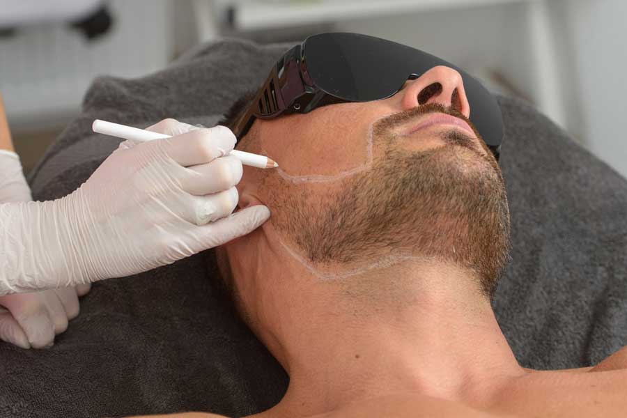 Laserontharing baard resultaat bij mannen