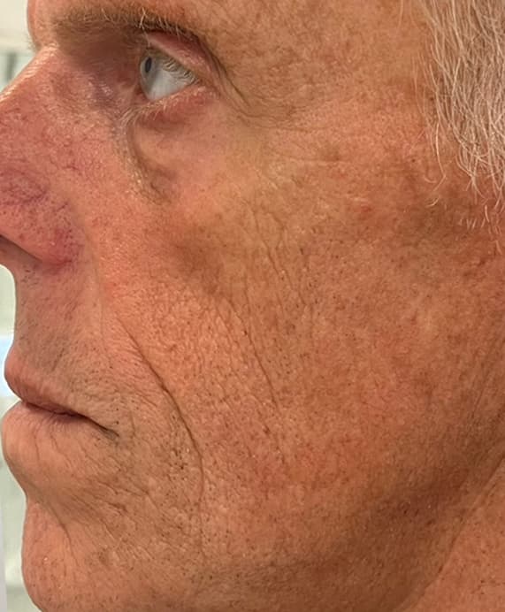 After HIFU Treatment - Cheeks