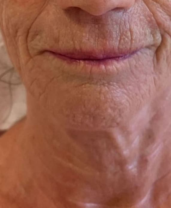After HIFU Treatment - Lips