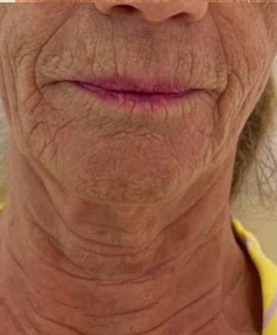 Before HIFU Treatment - Lips