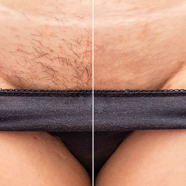 Laserontharing bikini resultaat bij vrouwen