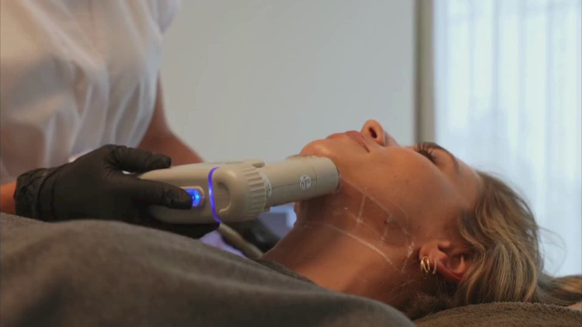 HIFU Treatment Timeline