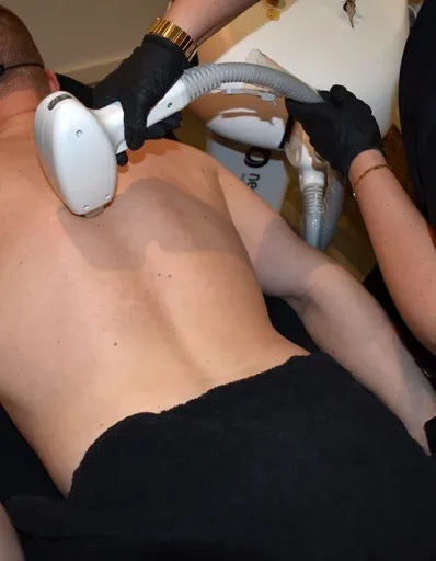 Laser hair removal for men